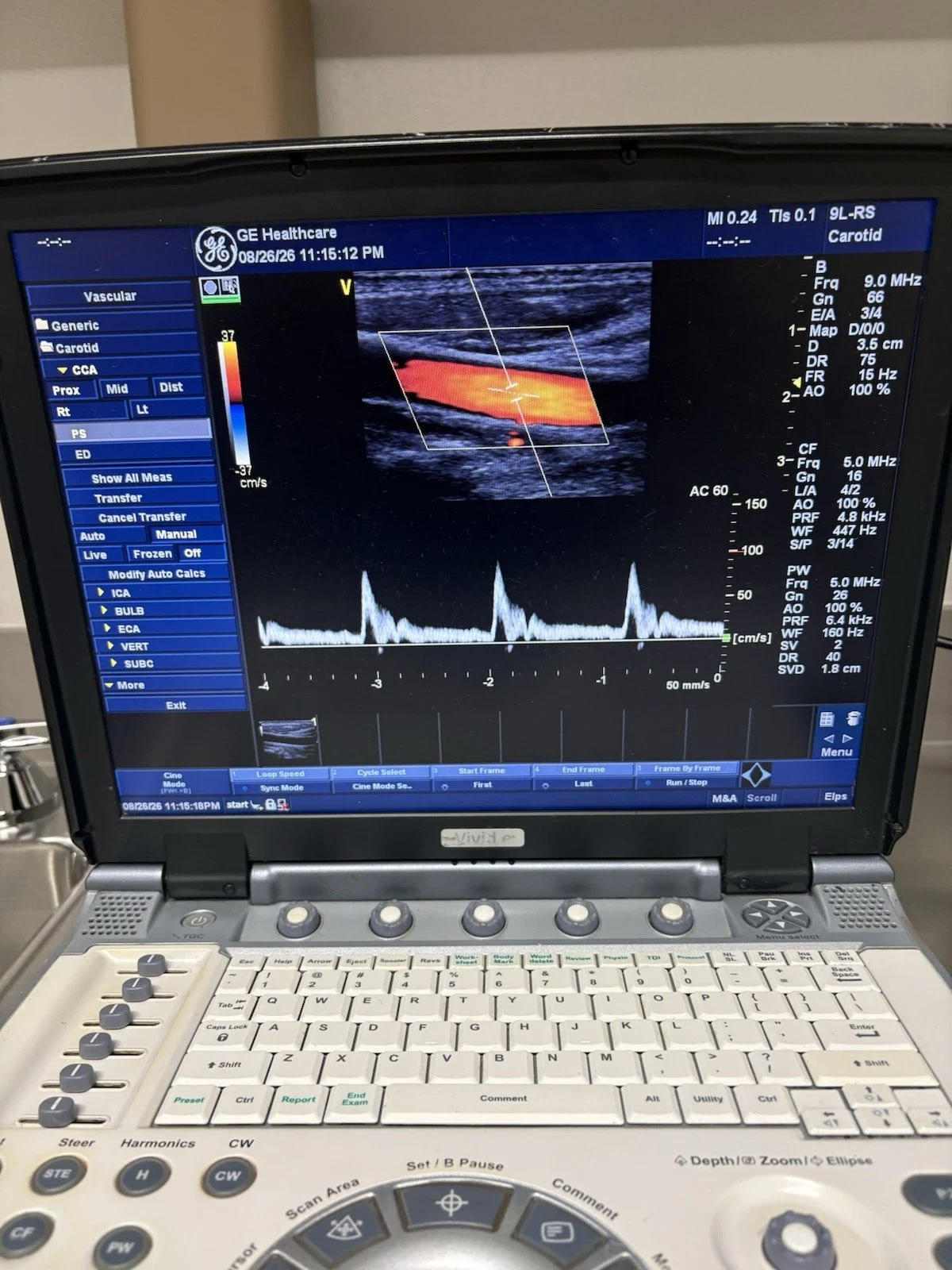 GE Vivid e Portable Cardiovascular Ultrasound with 3S-RS and 9L-RS Probes, Color and PW Doppler — Ultrasound Machines — view 2