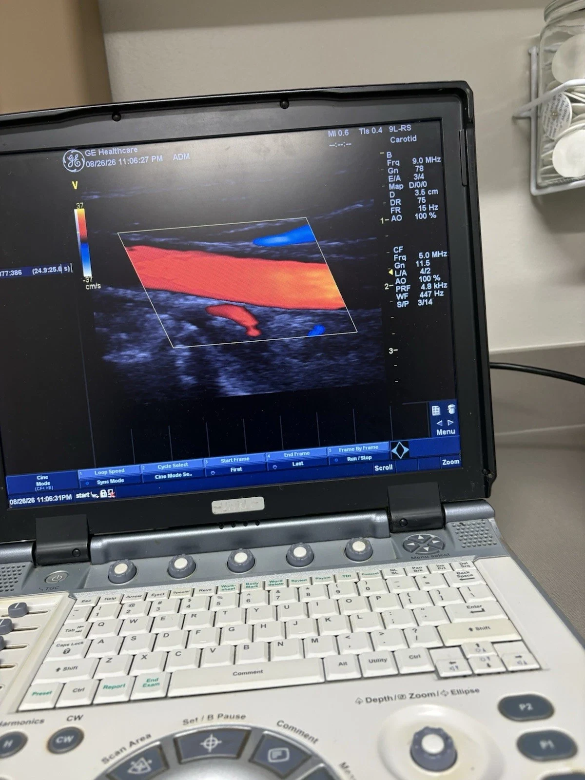 GE Vivid e Portable Cardiovascular Ultrasound with 3S-RS and 9L-RS Probes, Color and PW Doppler — Ultrasound Machines — view 3