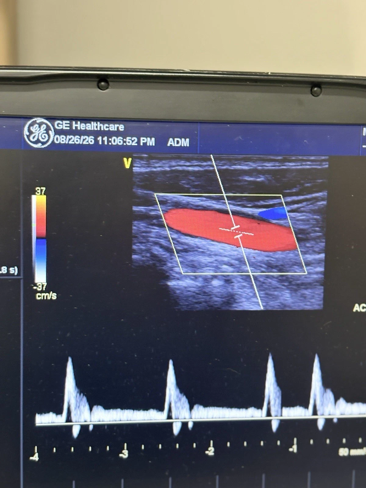 GE Vivid e Portable Cardiovascular Ultrasound with 3S-RS and 9L-RS Probes, Color and PW Doppler — Ultrasound Machines — view 5