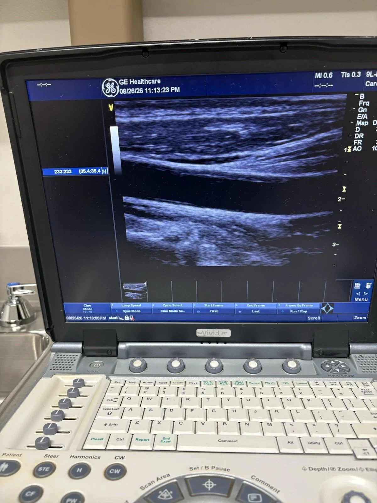 GE Vivid e Portable Cardiovascular Ultrasound with 3S-RS and 9L-RS Probes, Color and PW Doppler — Ultrasound Machines — view 7